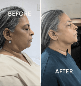 HIFU tightening for face and neck