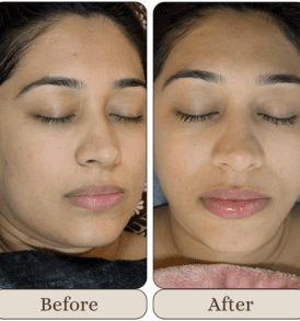 Carbon Laser Facial