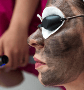 Carbon Laser Facial