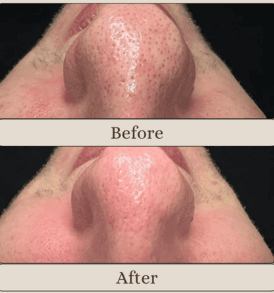 Carbon Laser Facial