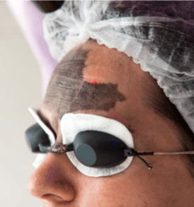 Carbon Laser Facial