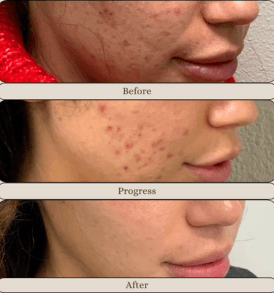 Hydrafacial process
