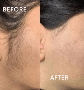 Q-Switch under eye treatment