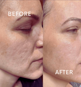 RF Skin Tightening for face and neck