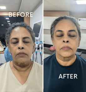 RF Skin Tightening for abdomen