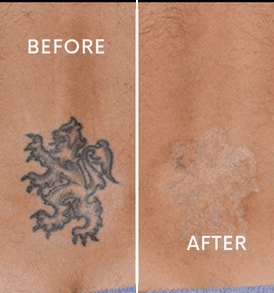 Laser removing small tattoo