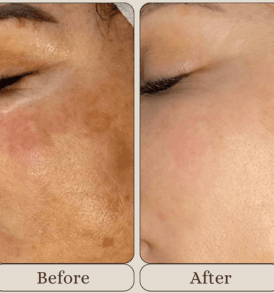 PRP Face Treatment