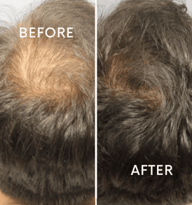 PRP Hair Treatment