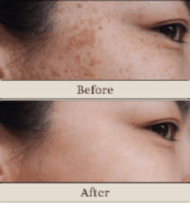 Q-Switch under eye treatment