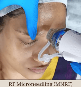 Target acne scars, stretch marks, and skin laxity with RF Microneedling for the back.
