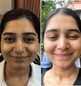 Skin Whitening IV Glutathione Drips