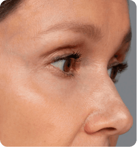 Carbon Laser Facial