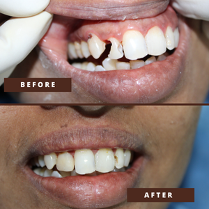 Smile Transformation 2