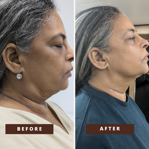 Smile Transformation 5