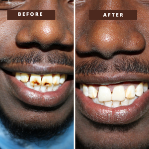 Smile Transformation 8