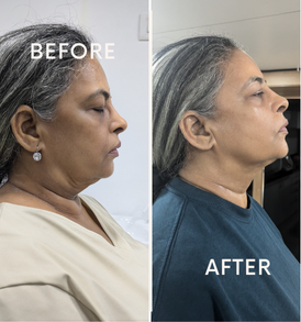 HIFU tightening for face and neck