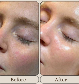 Carbon Laser Facial