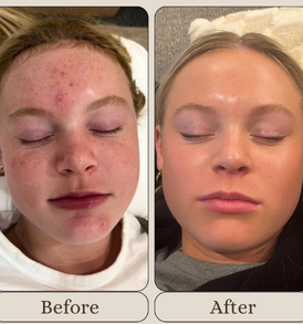 Mandelic Acid Chemical Peeling Treatment