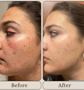 Mandelic Acid Chemical Peeling Treatment