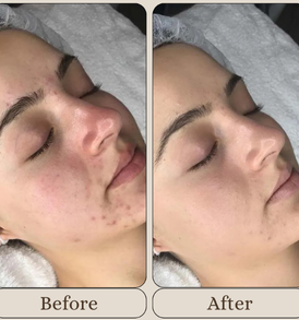 Mandelic Acid Chemical Peeling Treatment