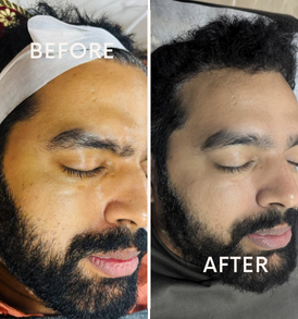 Mandelic Acid Chemical Peeling Treatment