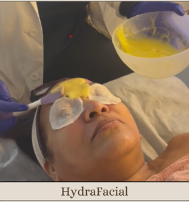 Hydrafacial treatment