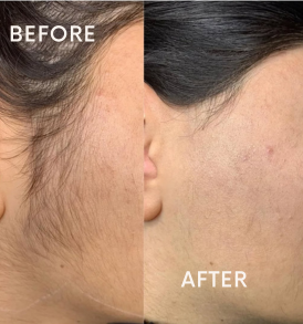 Q-Switch under eye treatment