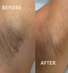 Q-Switch under eye treatment