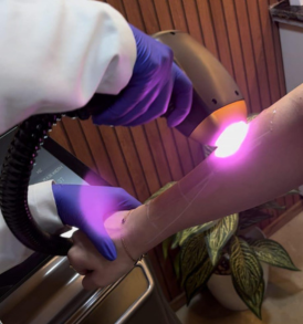 Q-Switch under eye treatment