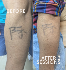 Laser removing medium tattoo