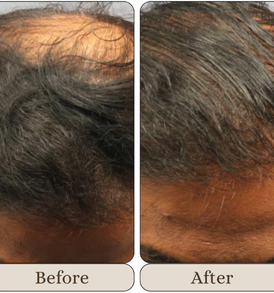 PRP Hair Treatment