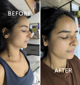 Q-Switch face treatment