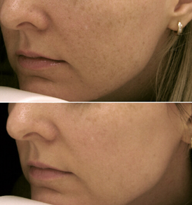 Q-Switch lip treatment