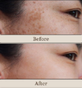 Q-Switch under eye treatment