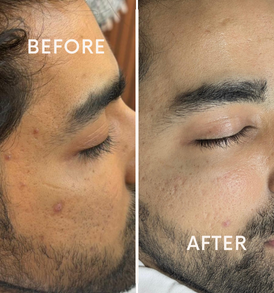 RF Microneedling MNRF