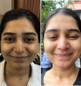 Skin Whitening IV Glutathione Drips